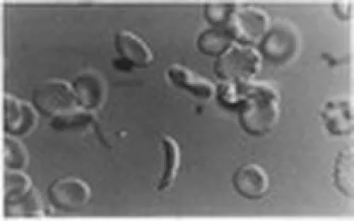 pitted RBCs
